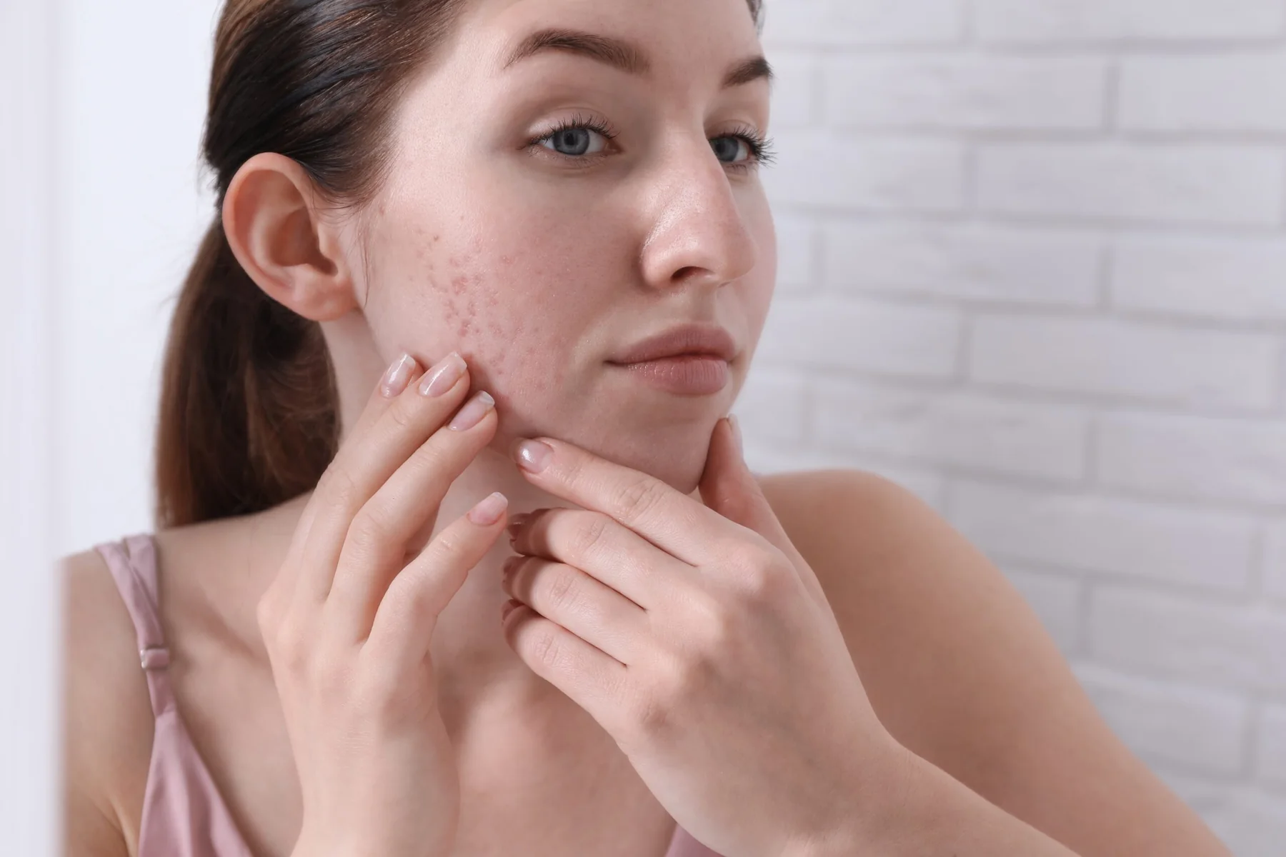 The Science Behind Microneedling for Acne Scars