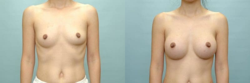 Breast augmentation before and after result, case 03