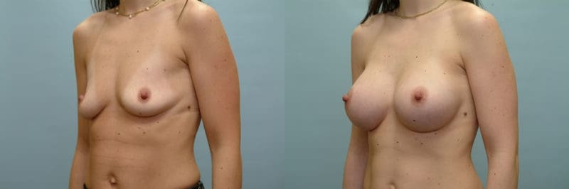 Breast augmentation before and after result, case 06