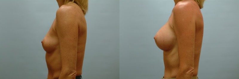 Breast augmentation before and after result, case 16