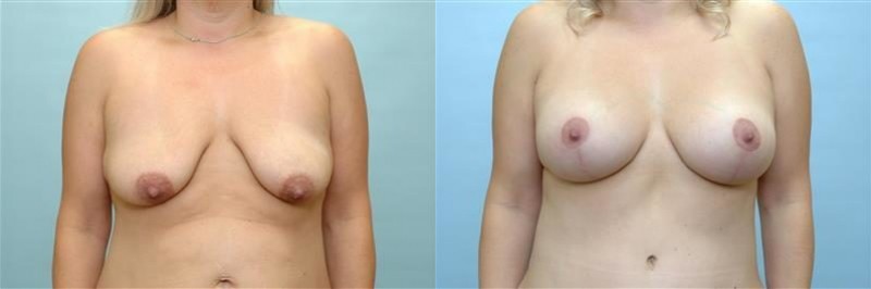 Breast lift + augmentation before and after result, case 05