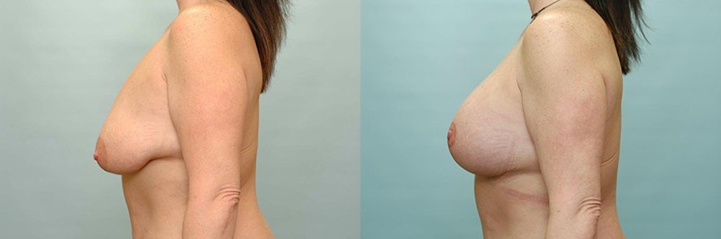 Breast lift + augmentation before and after result, case 08