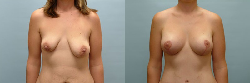 Breast lift + augmentation before and after result, case 11
