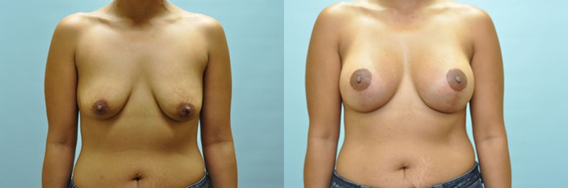 Breast lift + augmentation before and after result, case 13