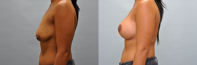 Breast lift + augmentation before and after result, case 14