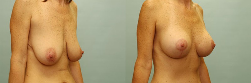 Breast lift + augmentation before and after result, case 16