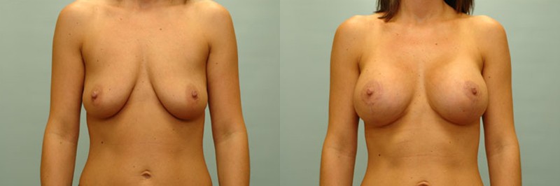Breast lift + augmentation before and after result, case 17