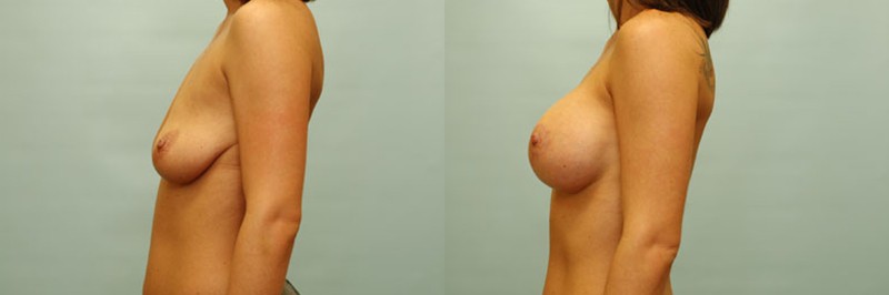 Breast lift + augmentation before and after result, case 18
