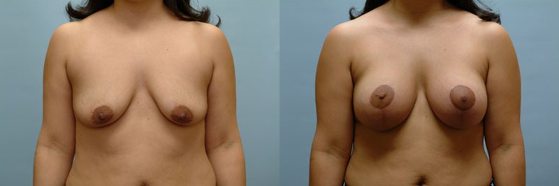 Breast lift + augmentation before and after result, case 19