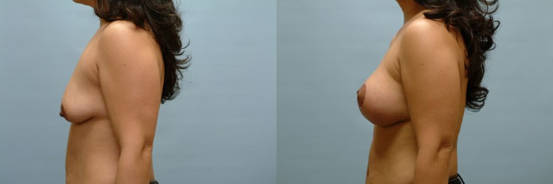 Breast lift + augmentation before and after result, case 20