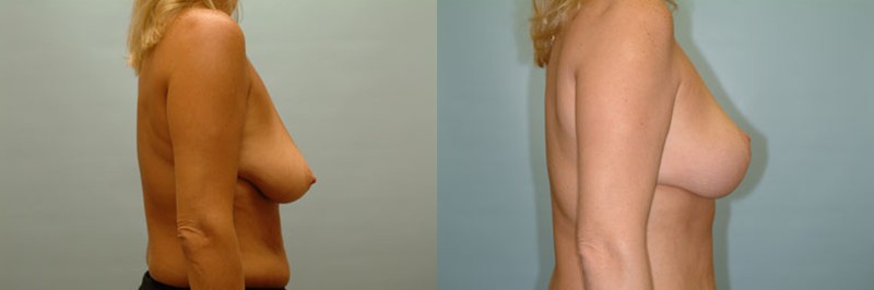 Breast lift only before and after result, case 04