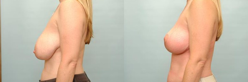 Breast lift only before and after result, case 06