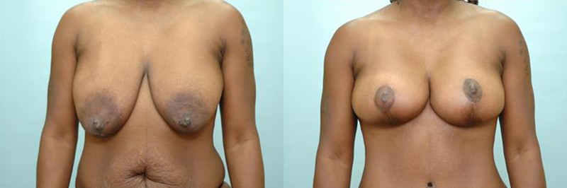 Breast lift only before and after result, case 07
