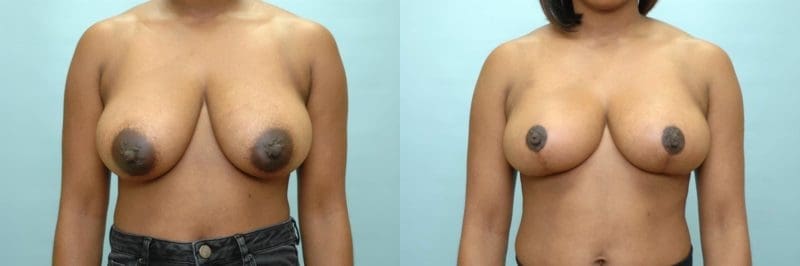 Breast reduction before and after result, case 01