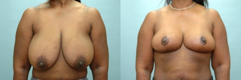 Breast reduction before and after result, case 02