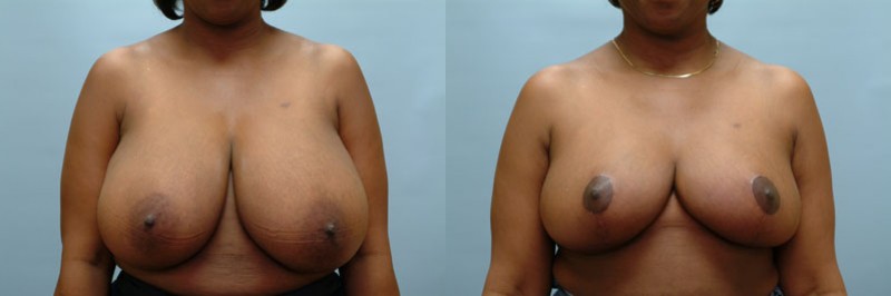 Breast reduction before and after result, case 05