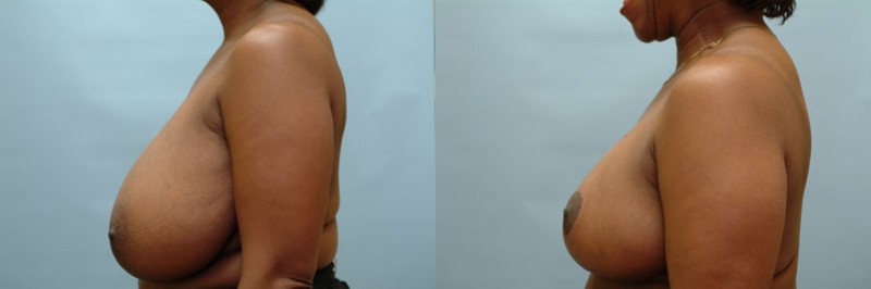Breast reduction before and after result, case 06