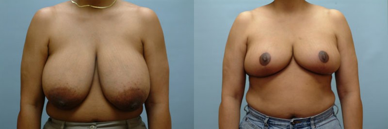 Breast reduction before and after result, case 07
