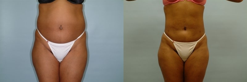 Liposuction before and after result, case 06