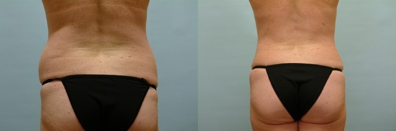 Liposuction before and after result, case 10