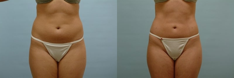 Liposuction before and after result, case 12