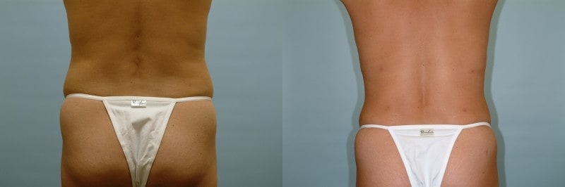 Liposuction before and after result, case 13