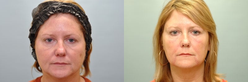 Med Spa treatments before and after result, case 08