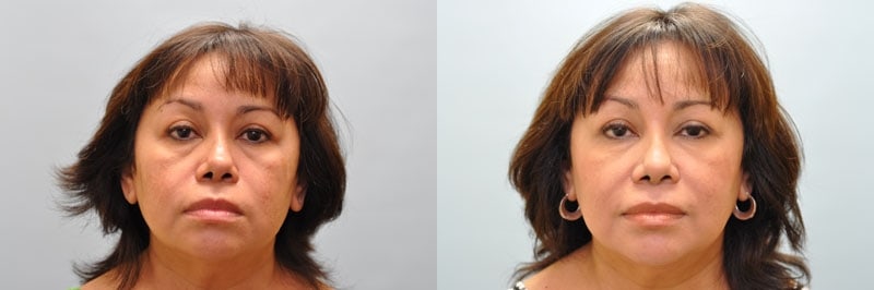 Med Spa treatments before and after result, case 09