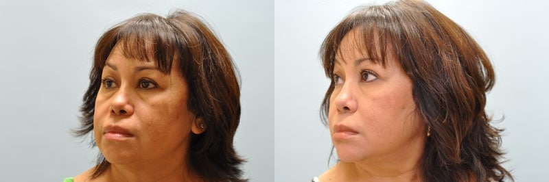 Med Spa treatments before and after result, case 11