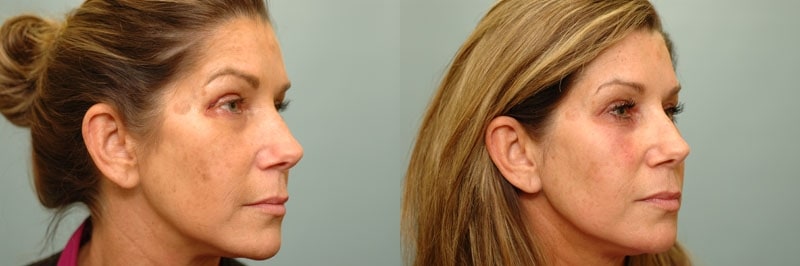 Med Spa treatments before and after result, case 14