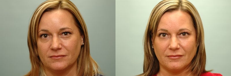Med Spa treatments before and after result, case 19