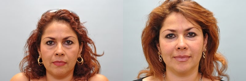 Med Spa treatments before and after result, case 23