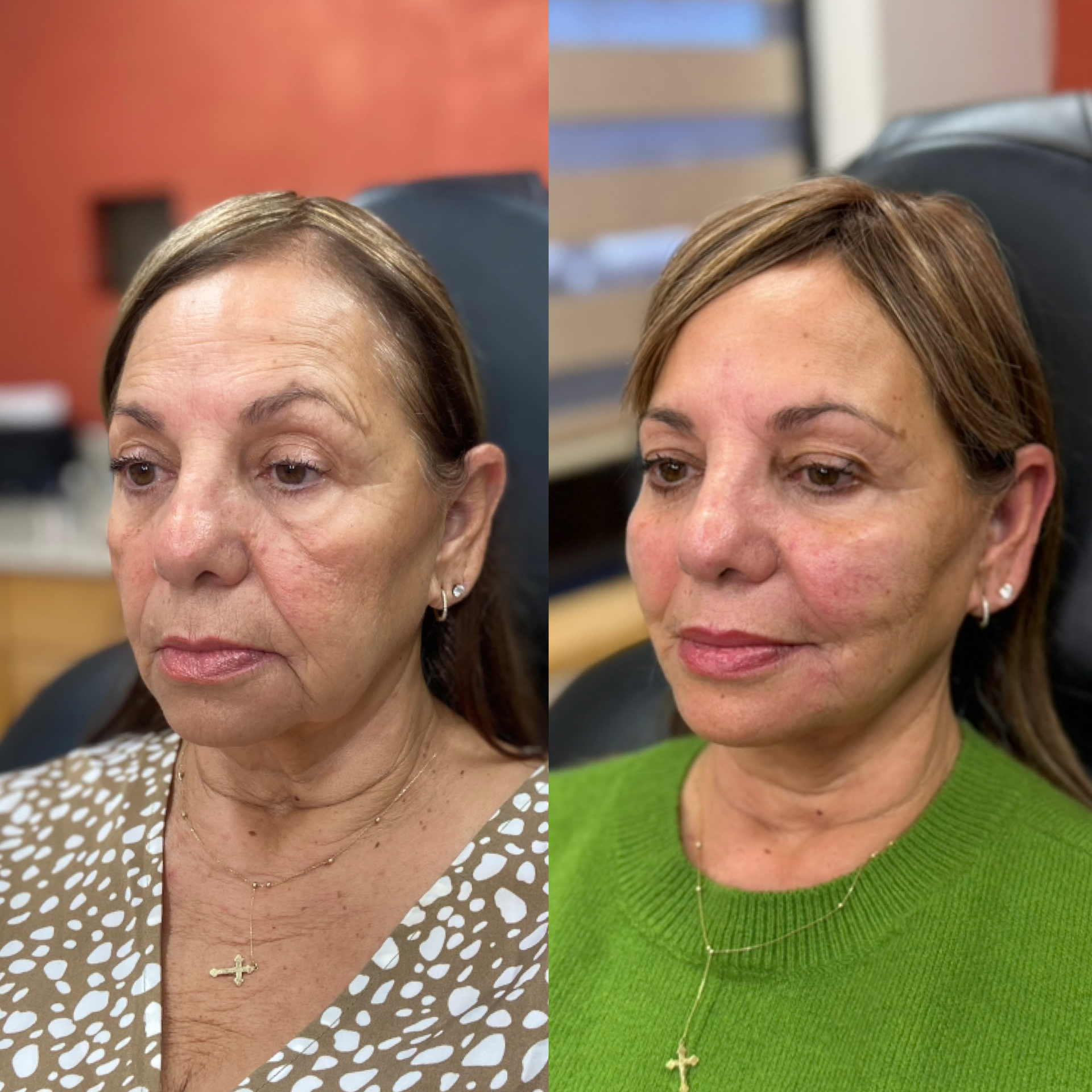 Med Spa treatments before and after result, case 04