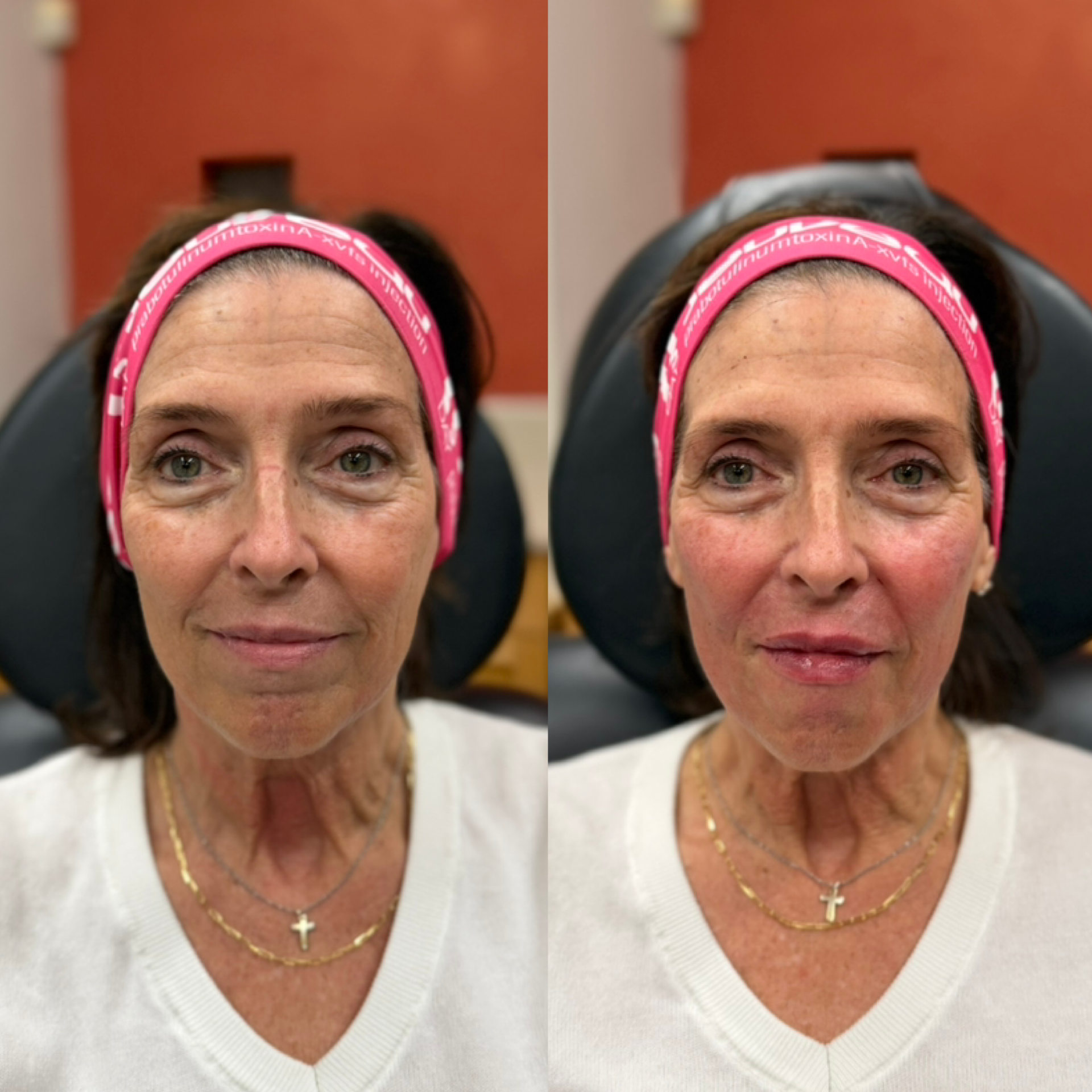 Med Spa treatments before and after result, case 06