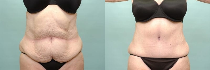 Tummy tuck before and after result, case 03