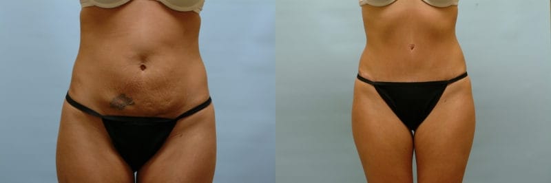 Tummy tuck before and after result, case 05