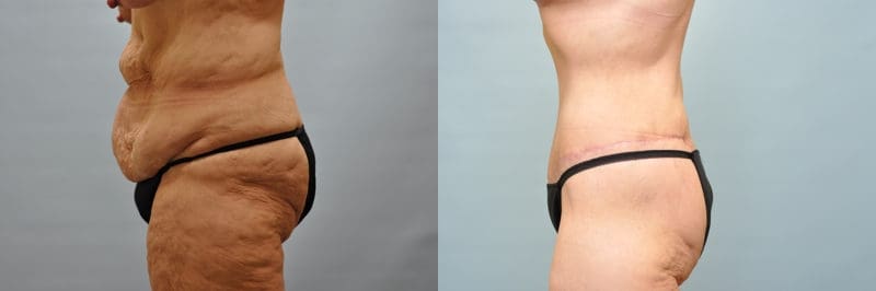 Tummy tuck before and after result, case 08