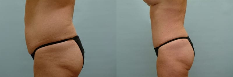 Tummy tuck before and after result, case 10