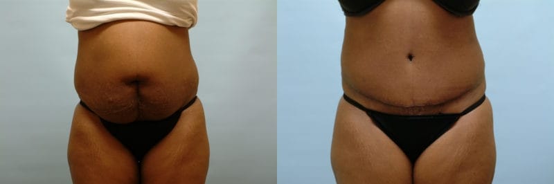 Tummy tuck before and after result, case 11