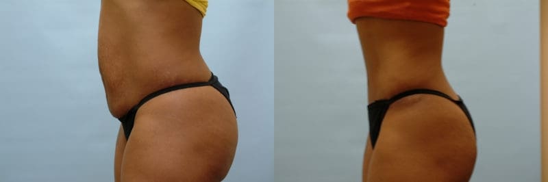 Tummy tuck before and after result, case 14