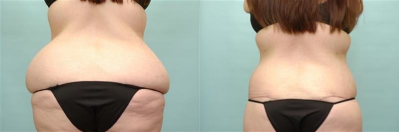 Waist tuck before and after result, case 01