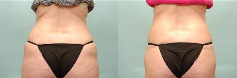 Waist tuck before and after result, case 02
