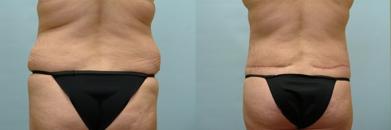 Waist tuck before and after result, case 03