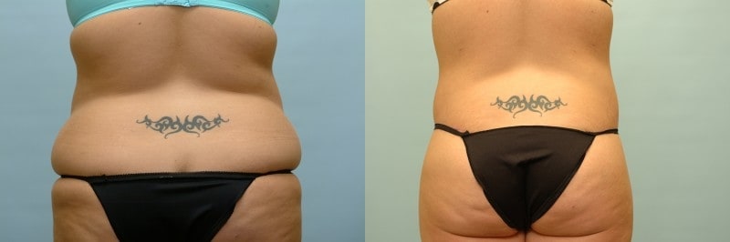 Waist tuck before and after result, case 05